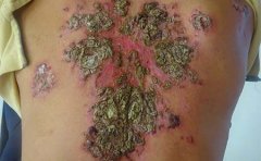 男人患上牛皮癣会有怎样的危害呢